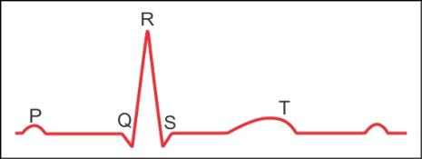 Draw a diagram of a standard ECG. Explain the parameters which are ...