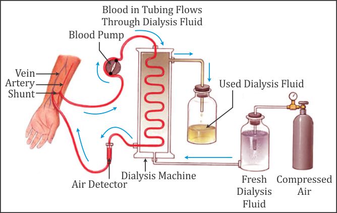 hemodialysis diagram