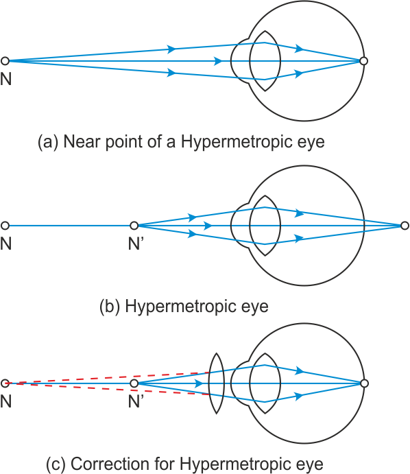 What Are The Causes Of Presbyopia Draw Labeled Diagram Of