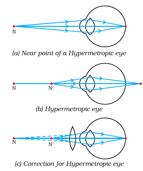 Hypermetropia lens