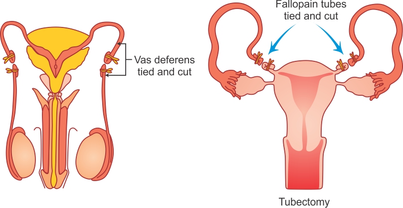 Describe Surgical Method Of Birth Control Biology Topperlearning Com Ksvuwxqq